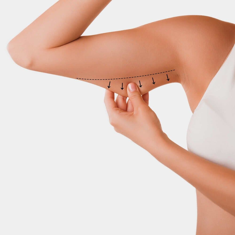 Arm Lift — Dr. Steven A. Fern