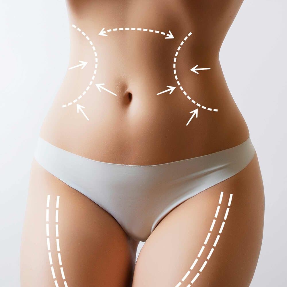 Liposuction