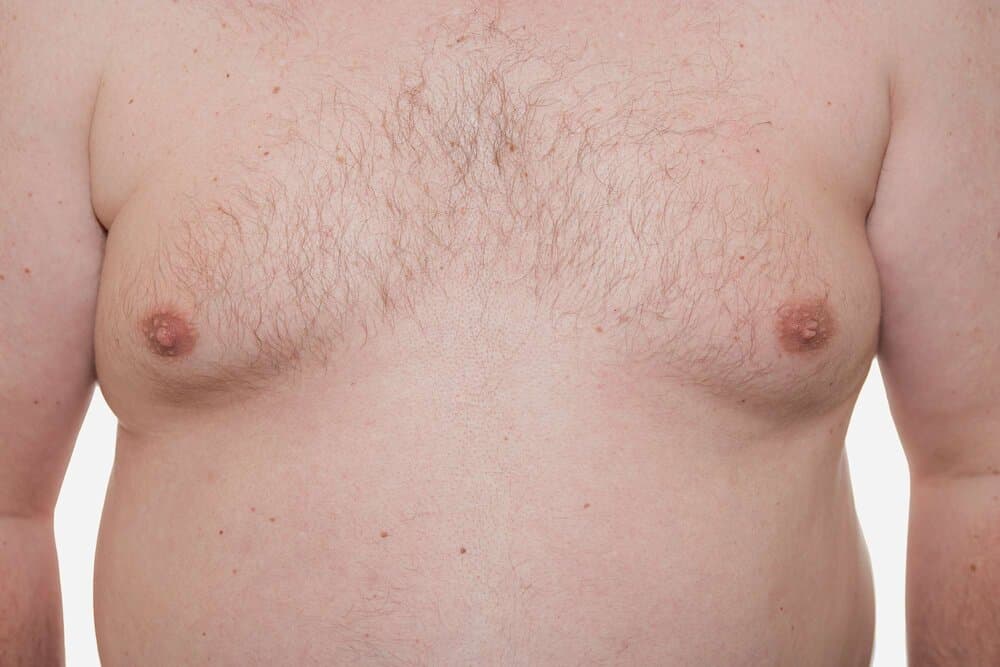 Gynecomastia: The Plastic Surgery Procedure Men Don't Talk About — But Should