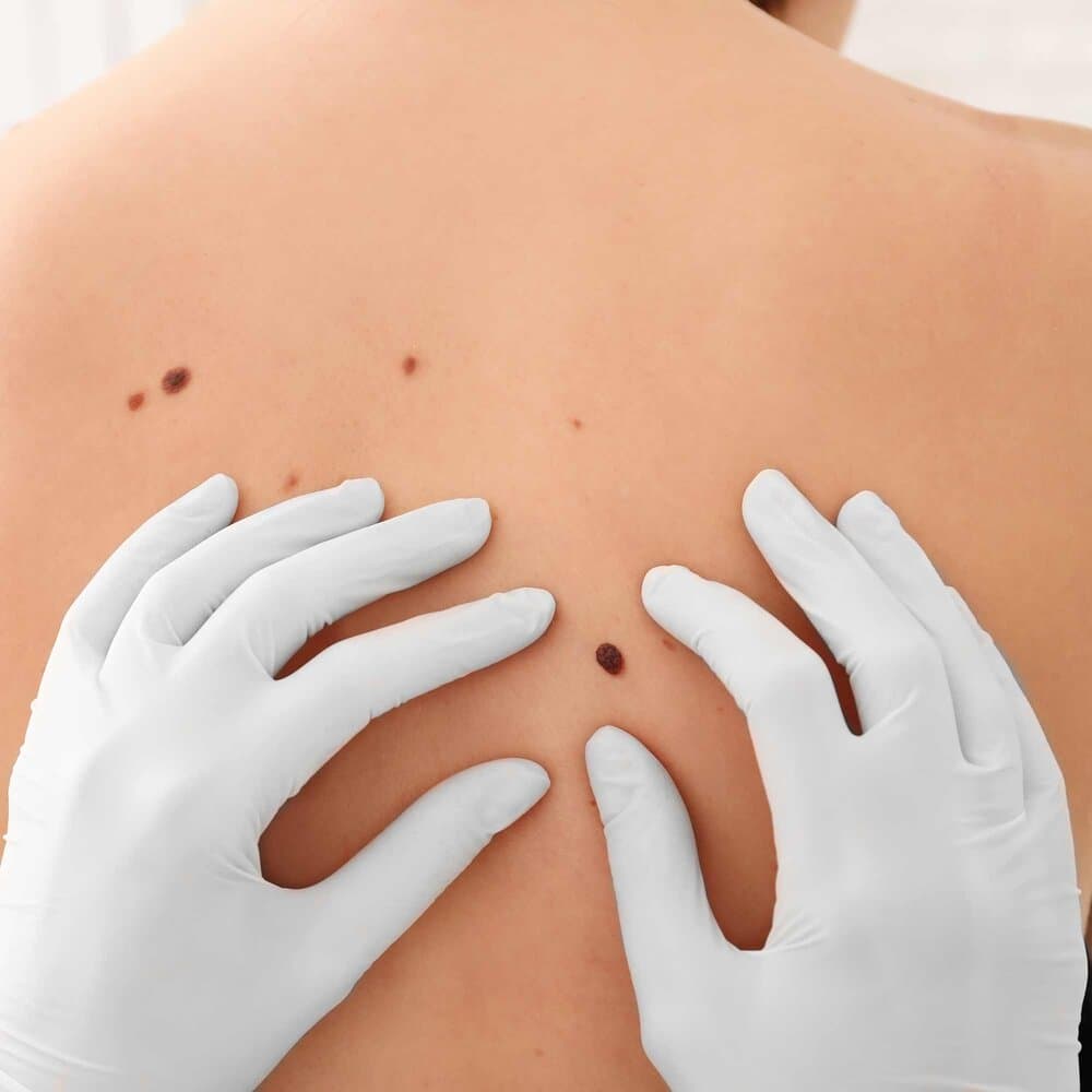 Skin Cancer Reconstruction