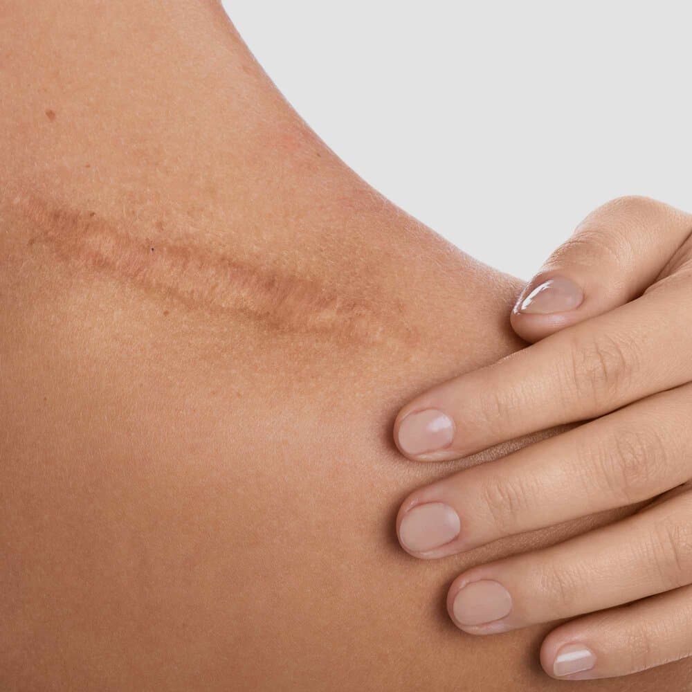 Scar Revision